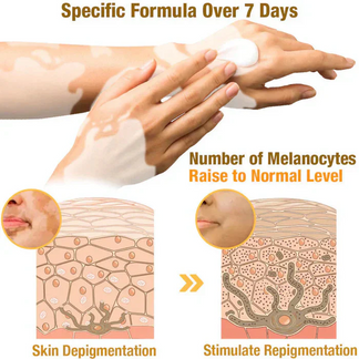 Bee Venom VitiGO Correcting Cream ⭐⭐⭐⭐⭐(4.9/5) (10000+ Verified Reviews)