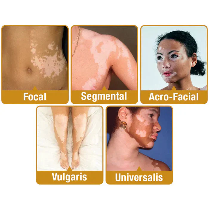Bee Venom VitiGO Correcting Cream ⭐⭐⭐⭐⭐(4.9/5) (10000+ Verified Reviews)