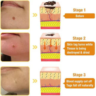 Bee Venom Skin Tag & Wart Remover Spray (BUY 1 GET 1 FREE) ⭐⭐⭐⭐⭐(4.9/5) (10000+ Verified Reviews)