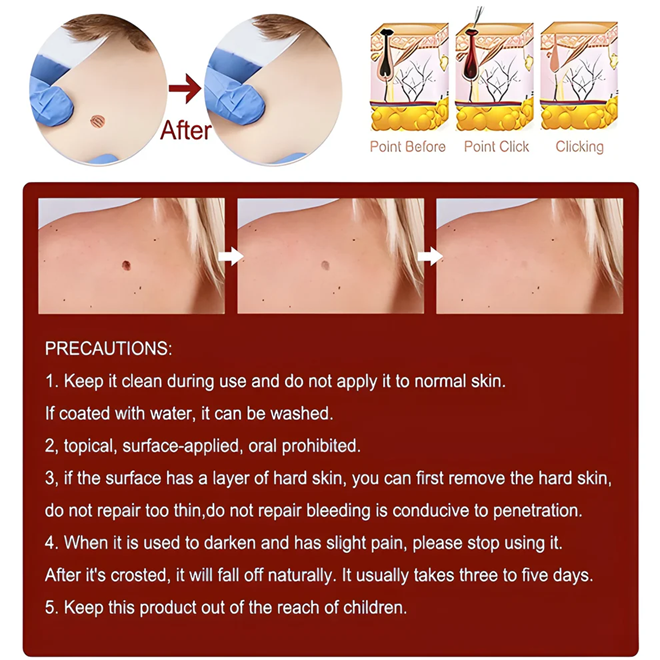 Advanced Skin Tag & Mole Remover - Professional Strength Treatment (Buy 1 Get 1 Free)