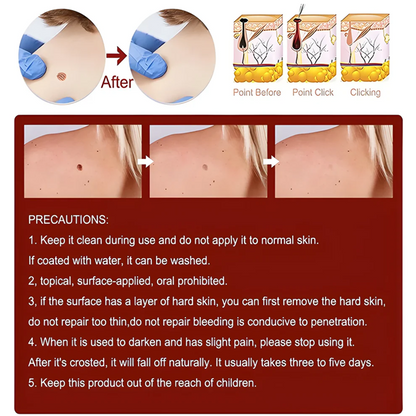 Advanced Skin Tag & Mole Remover - Professional Strength Treatment (Buy 1 Get 1 Free)