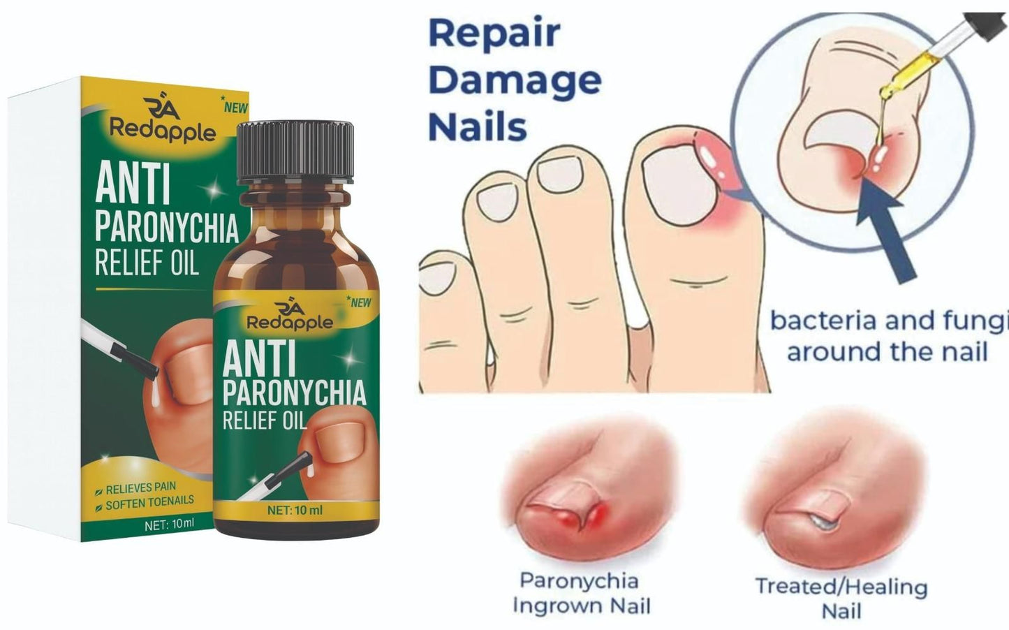 Anti Paronychia Relief Oil 10 ml Buy 1 Get 1 Free ⭐⭐⭐⭐⭐(4.9/5) (10000+ Verified Reviews)