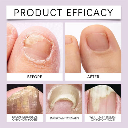 Fungi Free Bee Venom Nail Treatment Serum (Buy 1 Get 1 Free) ⭐⭐⭐⭐⭐(4.9/5) (10000+ Verified Reviews)