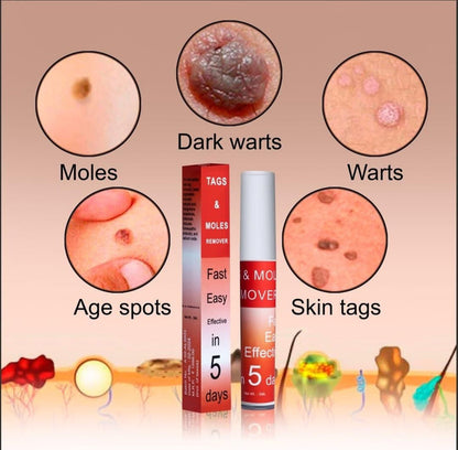 Advanced Skin Tag & Mole Remover - Professional Strength Treatment (Buy 1 Get 1 Free)