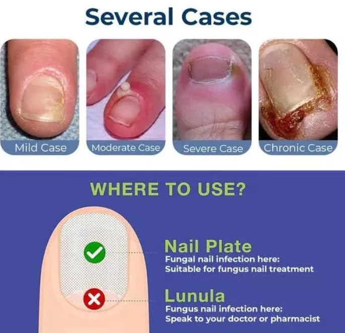 Anti Paronychia Relief Oil 10 ml Buy 1 Get 1 Free ⭐⭐⭐⭐⭐(4.9/5) (10000+ Verified Reviews)