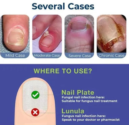 Anti Paronychia Relief Oil 10 ml Buy 1 Get 1 Free ⭐⭐⭐⭐⭐(4.9/5) (10000+ Verified Reviews)