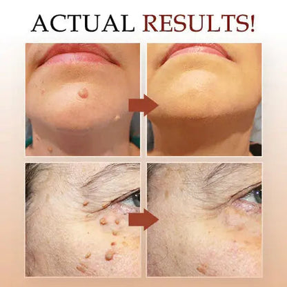 Advanced Skin Tag & Mole Remover - Professional Strength Treatment (Buy 1 Get 1 Free)