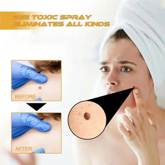 Bee Venom Skin Tag & Wart Remover Spray (BUY 1 GET 1 FREE) ⭐⭐⭐⭐⭐(4.9/5) (10000+ Verified Reviews)